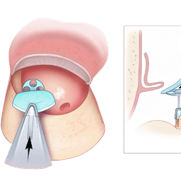Ossiculoplasty Ear Surgery