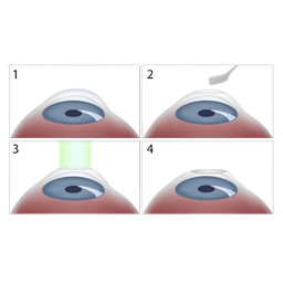 Photorefractive Keratectomy (PRK)