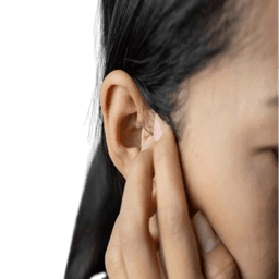 Preauricular Skin Tag Removal