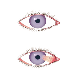 Pterygium Removal Surgery