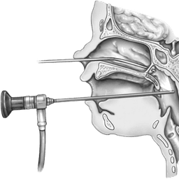 Repair of Choanal Atresia