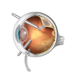 Retinal Detachment Surgery
