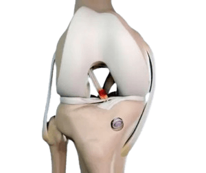 Revision ACL Reconstruction Surgery