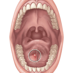 Salivary Gland Stone Removal