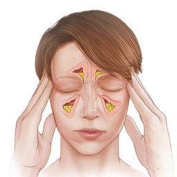 Sinusitis (Sinus Infection)