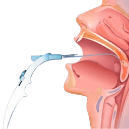 Somnoplasty Snoring Surgery