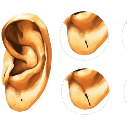 Split Earlobe Repair Surgery
