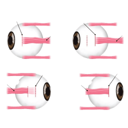 Strabismus Surgery - Eye Muscle Surgery