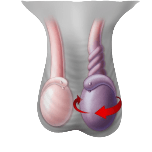 Testicular Torsion Surgery