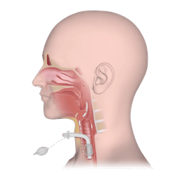 Tracheostomy