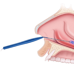 Turbinate Reduction Surgery