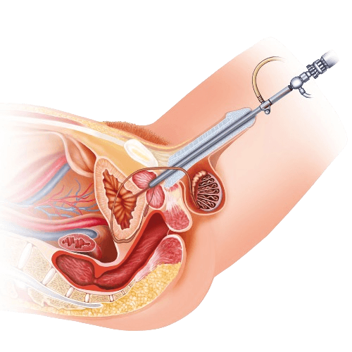 Urethral Stricture Surgery