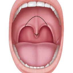 Uvulopalatopharyngoplasty (UPPP)