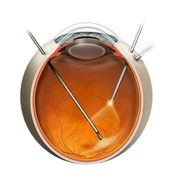 Vitrectomy