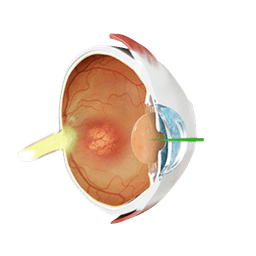YAG Laser Capsulotomy