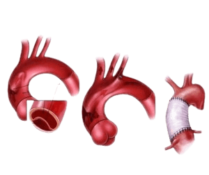 Aorta diseksiyasini tikish jarrohligi
