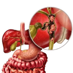 Bile Duct Cancer