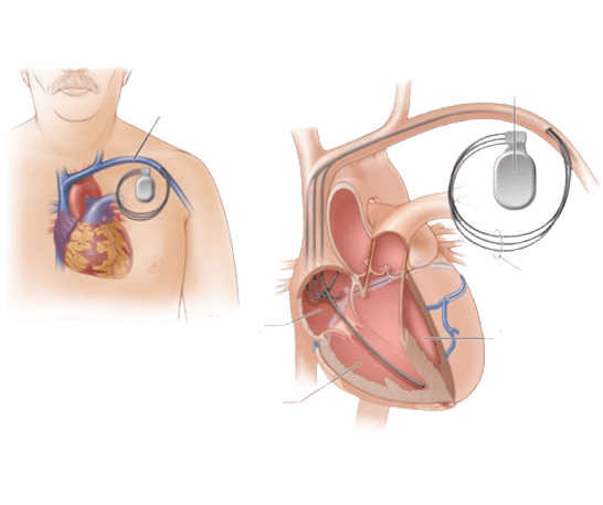 ការกระตุ้นหัวใจทั้งสองห้อง (Biventricular Pacing)