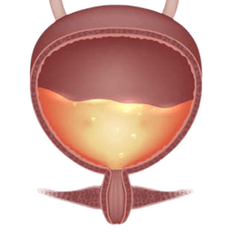 Bladder Instillation