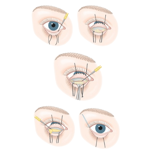 Blefaroplastika Qovoq Jarrohligi