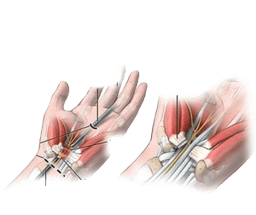 Carpal Tunnel Release Open or Endoscopic CTR