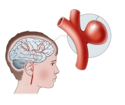 Cerebral of Brain Aneurysm