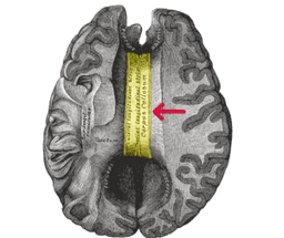 Corpus Callosotomy