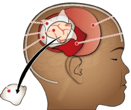 Craniotomy Surgery