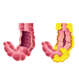 Crohn's Disease