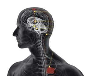 Parkinson kasalligi uchun chuqur miya stimulyatsiyasi