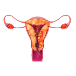 Endometrial Cancer