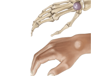 Ganglion kistasining olib tashlanishi
