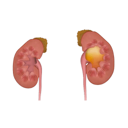 Hydronephrosis