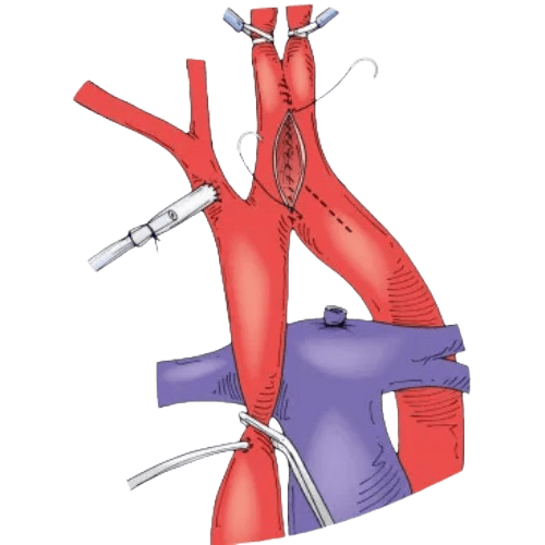 Uzatilgan Aorta Yoyining Jarrohligi