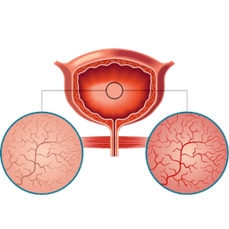 Interstitial Cystitis
