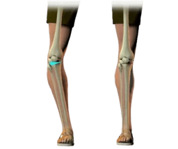 Knee Osteotomy