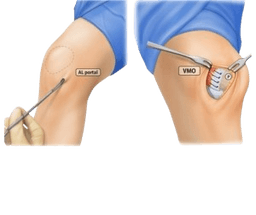 Lateral Retinacular Release Surgery