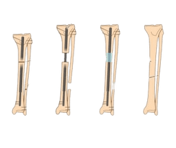 Limb Lengthening Surgery