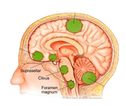 Meningioma