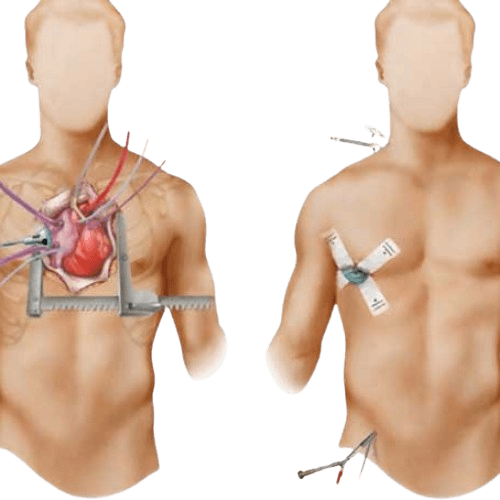 Mitral qopqochasini almashtirish