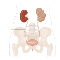 Multicystic Dysplastic Kidney (MCDK)
