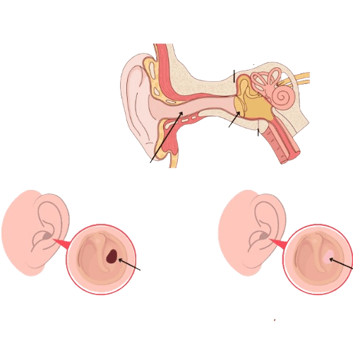Tog‘ay plastikasi (Miringoplastika)