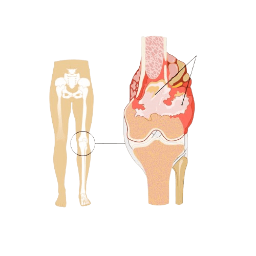 Osteosarkoma