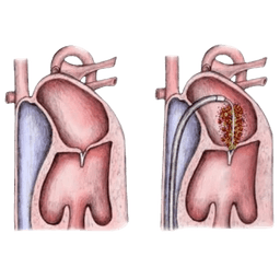 Percutaneous Transvenous Mitral Commissurotomy-PTMC