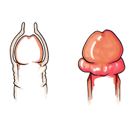 Phimosis & Paraphimosis