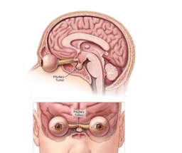 Pituitary Tumor