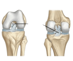 Posterior Cruciate Ligament Reconstruction (PCL)