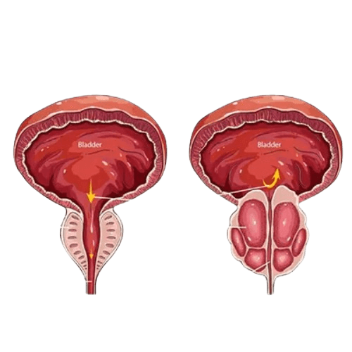Prostata saratoniga qarshi jarrohlik amaliyoti
