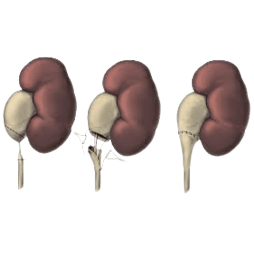 Pieloplastika