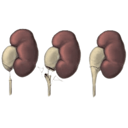 Pyeloplasty